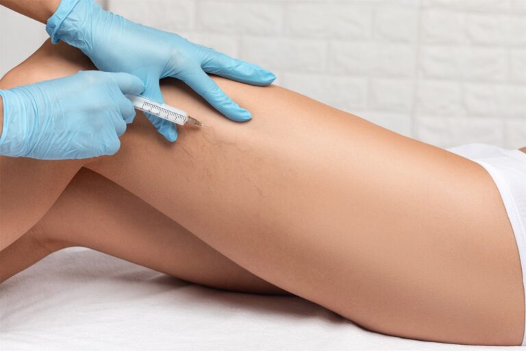Sclerotherapy-featured-image